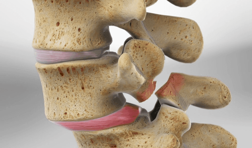 Spondylolisthesis: Causes, Symptoms & Relief | Precision Pain & Spine Institute