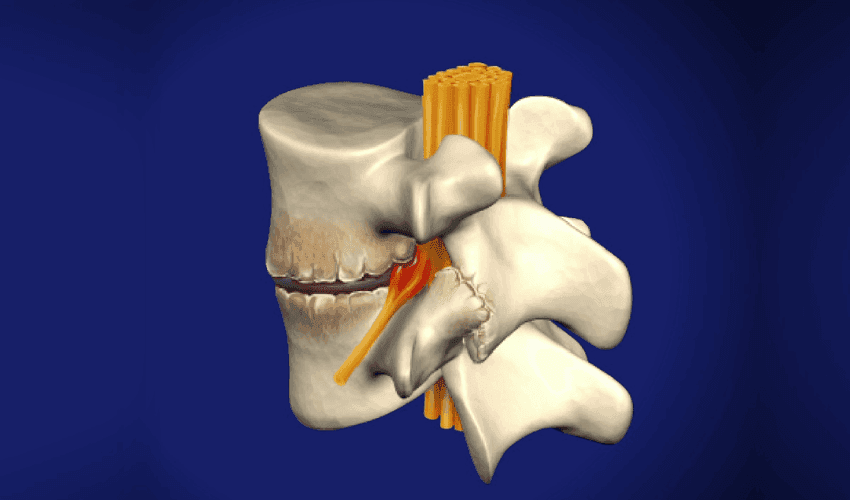 Spondylosis: Causes, Symptoms & Relief | Precision Pain & Spine Institute