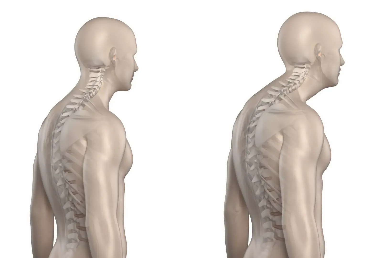 Kyphosis: Causes, Symptoms & Relief | Precision Pain & Spine Institute